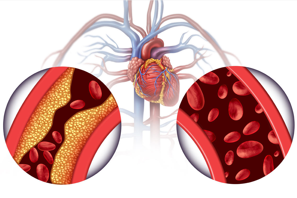 Ipertensione arteriosa