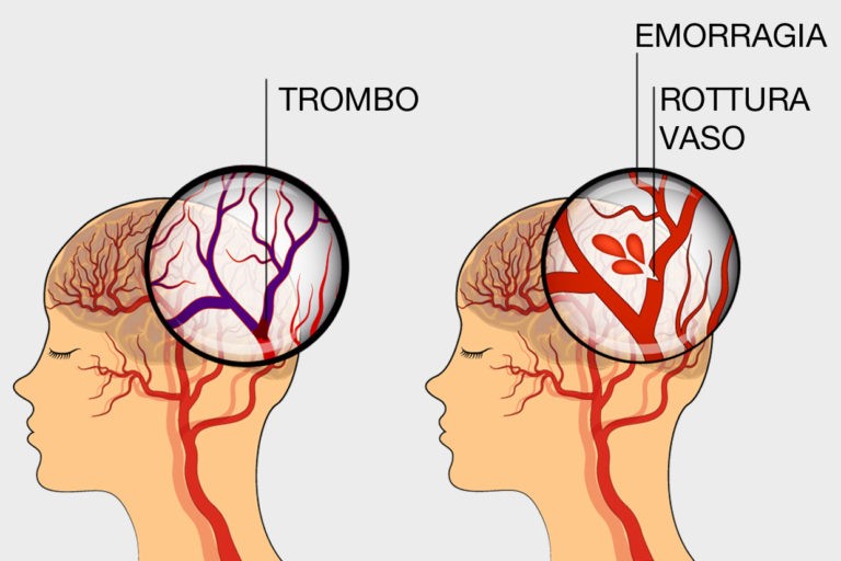 Differenza Tra Ictus E Emorragia Cerebrale Ictus Cerebrale, cos'è e come si manifesta | Prevenzione Ictus