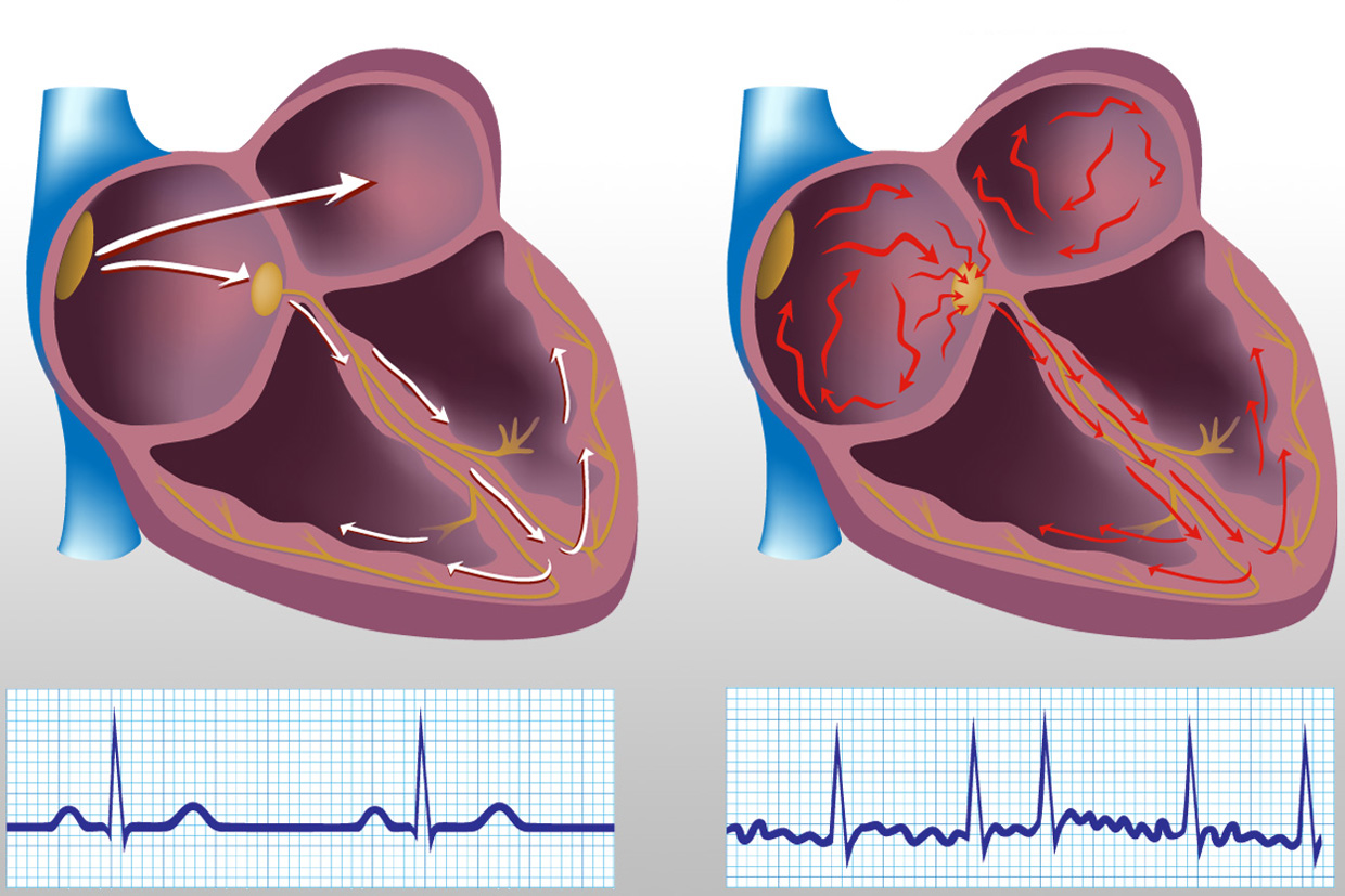 fibrillazione atriale