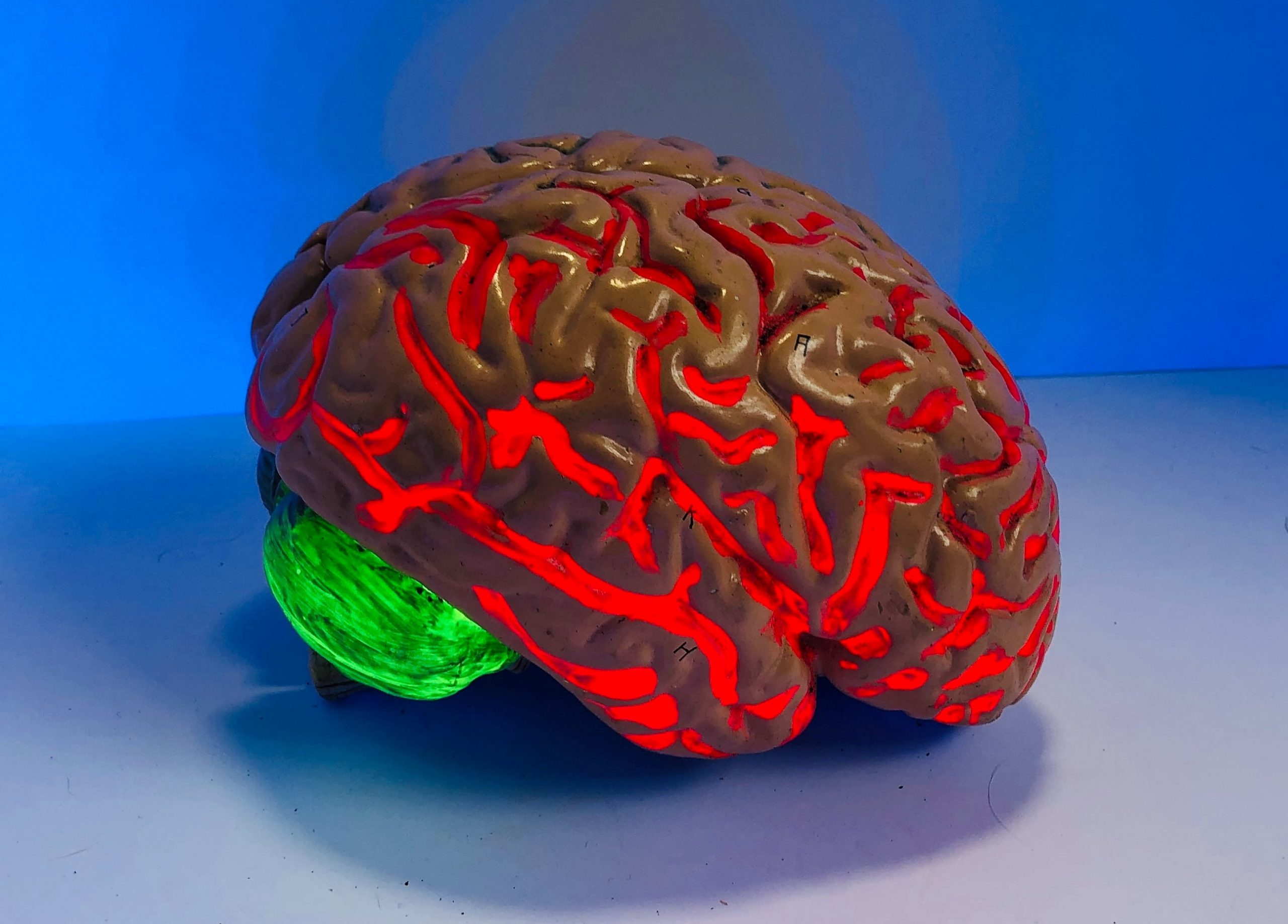 ictus ischemico cervello